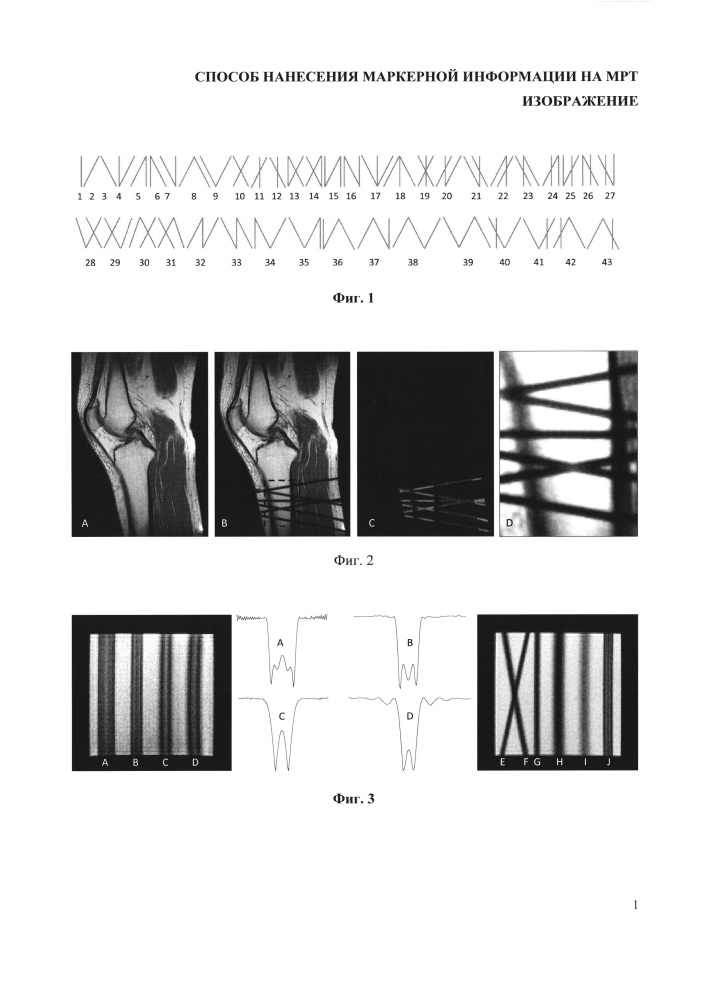 Способ нанесения маркерной информации на мрт изображение (патент 2664169)