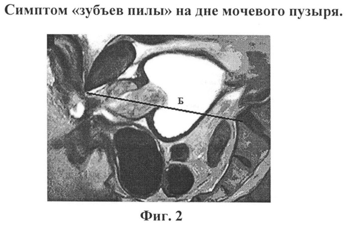 Аденома простаты недержание мочи. Рентген мочевой пузырь гиперплазия предстательной железы. Аденома простаты на рентгеновском снимке. Аденома с прорастанием в мочевой пузырь.