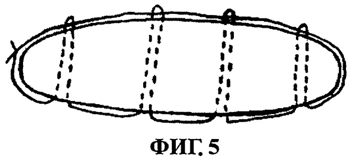 Способ ушивания культи селезенки при ее резекции (патент 2267298)