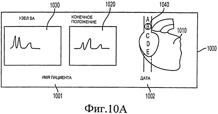 Способ позиционирования конца катетера (патент 2549998)