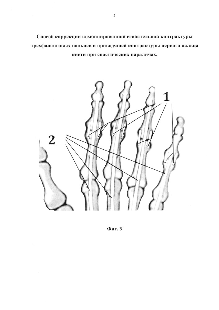 Способ коррекции комбинированной сгибательной контрактуры трехфаланговых пальцев и приводящей контрактуры первого пальца кисти при спастических параличах (патент 2627291)