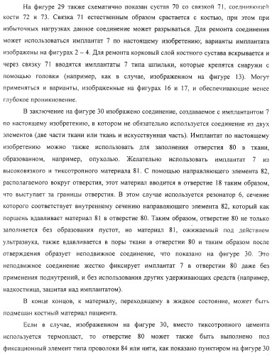 Имплантаты для создания соединений с тканями, в частности со скелетом, а также устройство и способ имплантации (патент 2314768)