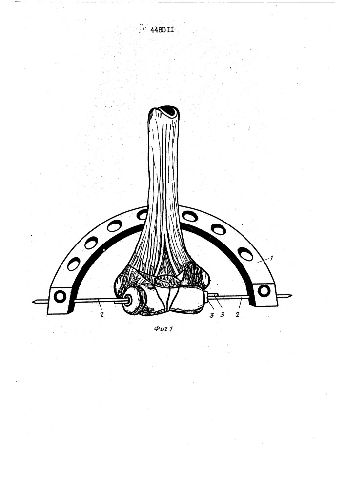 Устройство для репозиции и сращивания костных отломков (патент 448011)