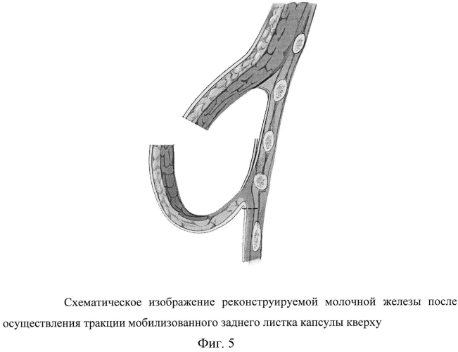 Способ формирования инфрамаммарной складки при двухэтапной реконструкции молочной железы (патент 2567790)