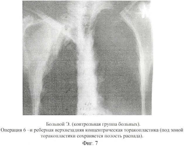 Способ хирургического лечения туберкулеза легких (патент 2417762)