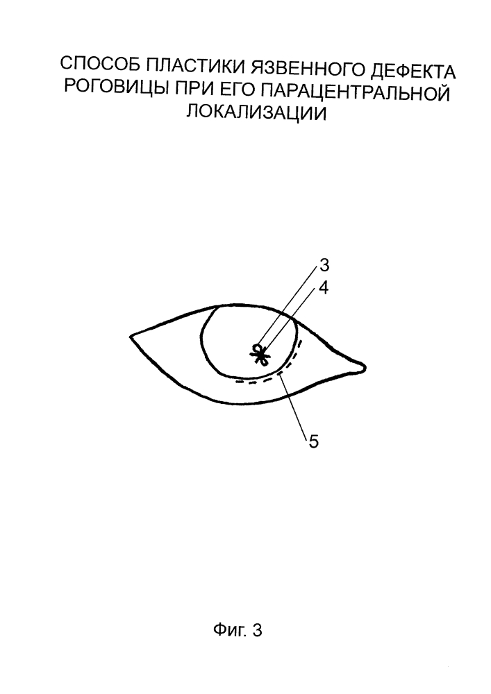 Способ пластики язвенного дефекта роговицы при его парацентральной локализации (патент 2644297)