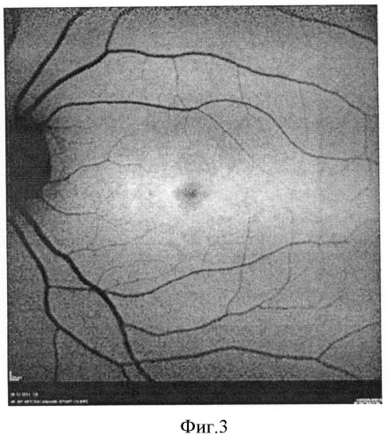 Способ дифференциальной диагностики различных стадий болезни штаргардта (патент 2497436)