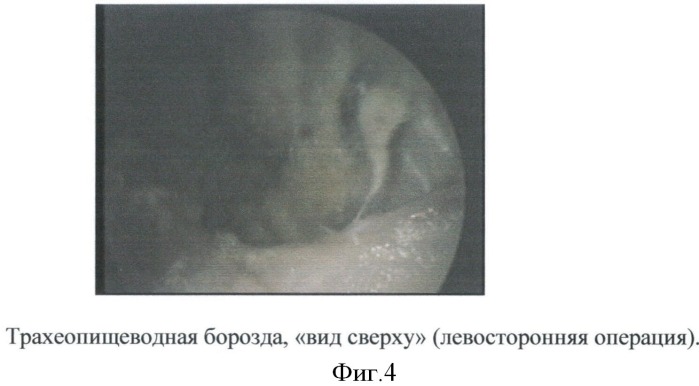 Способ эндовидеохирургической гемитиреоидэктомии (патент 2511461)