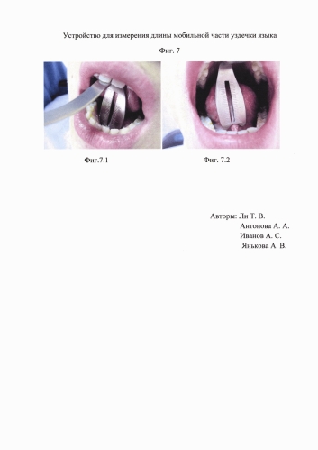 Устройство для измерения длины части уздечки языка (патент 2579279)