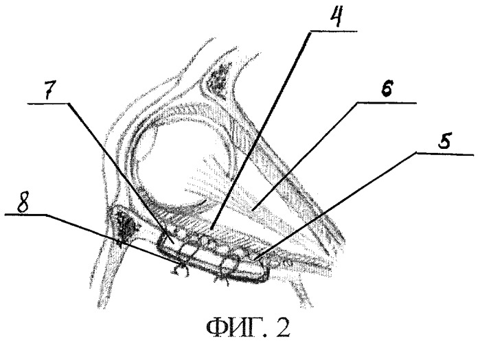 Способ реконструкции стенок глазницы при переломе (патент 2286110)