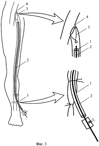 Устройство для лечения варикозной болезни и способ лечения варикозной болезни (патент 2260450)