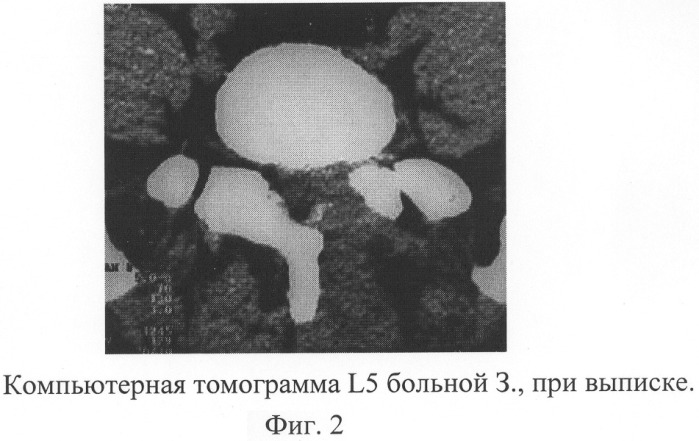 Способ лечения грыжи межпозвонкового диска (патент 2281055)