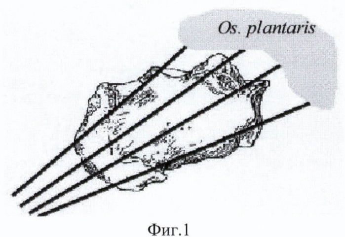 Способ лечения переломов пяточной кости (патент 2368341)