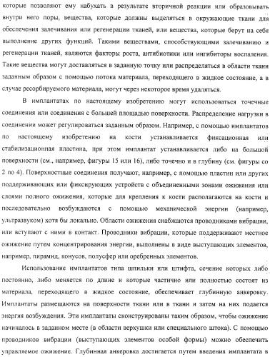 Имплантаты для создания соединений с тканями, в частности со скелетом, а также устройство и способ имплантации (патент 2314768)