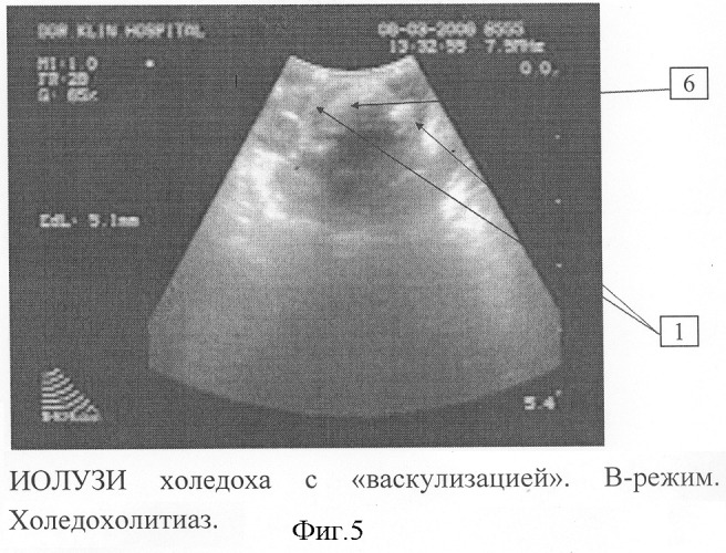 Способ интраоперационной диагностики патологии желчевыводящих протоков при лапароскопических операциях (патент 2310386)