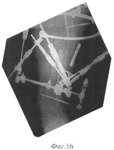 Способ остеосинтеза аппаратом орто-сув для лечения повреждений дистальной трети бедренной кости (патент 2448663)