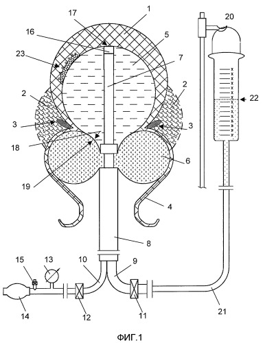 Способ лечения маточного послеродового кровотечения и двухбаллонный катетер для его осуществления (патент 2410047)