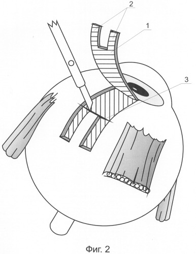Способ хирургического лечения глаукомы (патент 2290149)