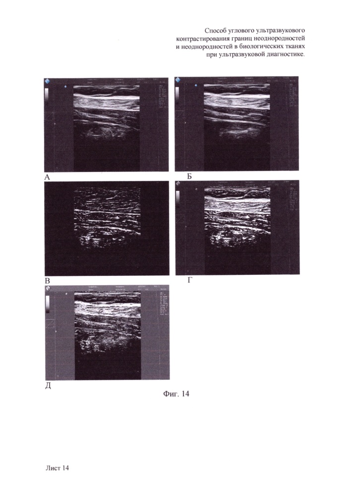 Способ углового ультразвукового контрастирования границ неоднородностей и неоднородностей в биологических тканях при ультразвуковой диагностике (патент 2648880)