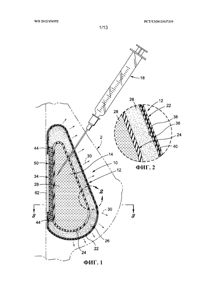 Заполняемые протезы и способы их изготовления (патент 2615372)