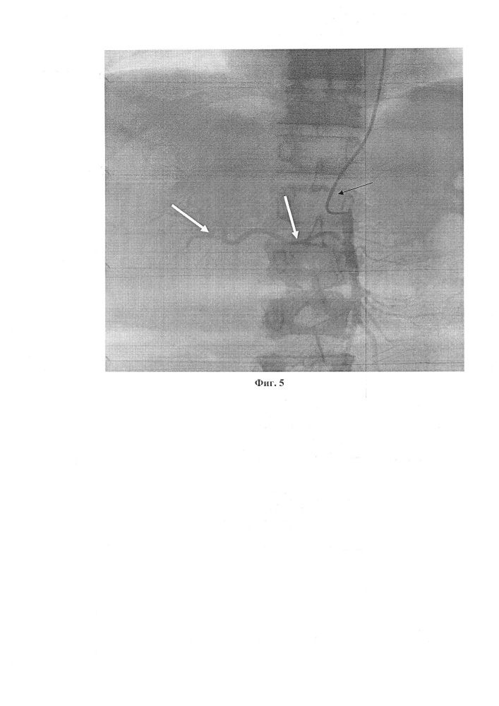Способ рентгенэндоваскулярной эмболизации висцеральных ветвей через артерии верхних конечностей при помощи катетера headhunter при различных патологиях желудочно-кишечного тракта (патент 2652743)