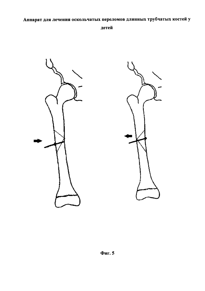 Аппарат для лечения оскольчатых переломов бедренной кости у детей (патент 2629050)