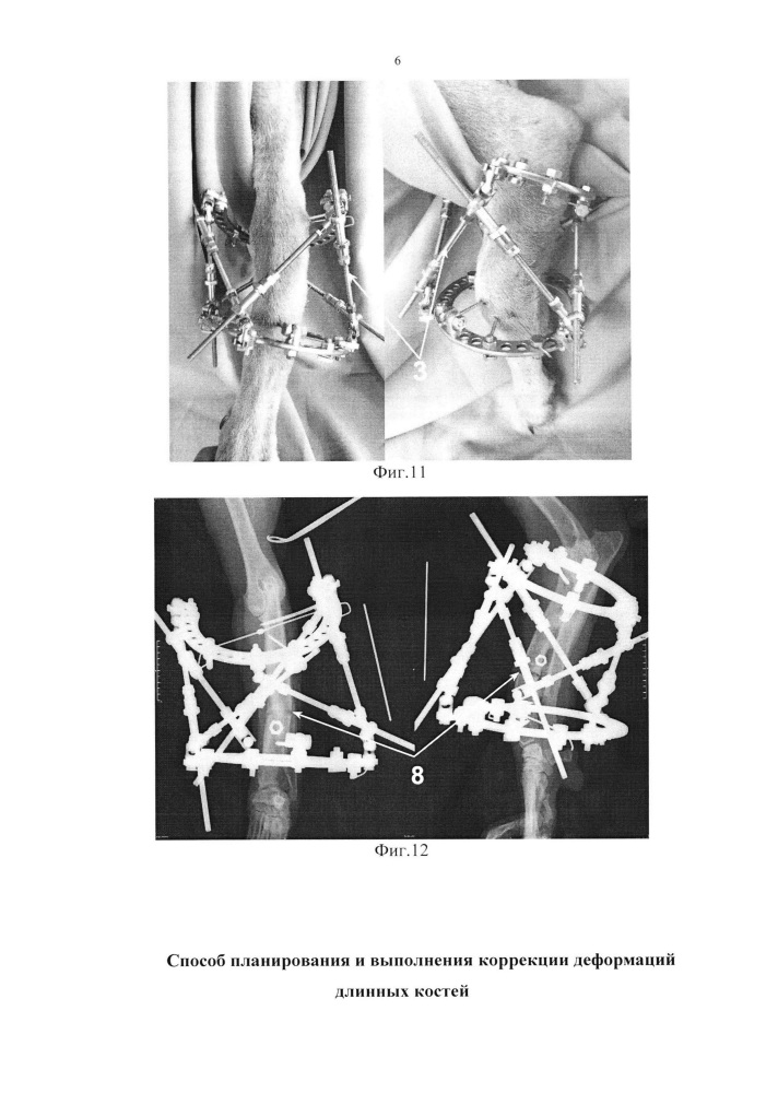 Способ планирования и выполнения коррекции деформаций длинных костей (патент 2641840)