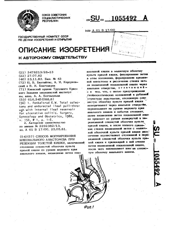 Способ формирования илеоанального анастомоза при резекции толстой кишки (патент 1055492)