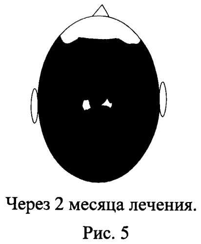 Метод лечения андрогенной алопеции: местное нанесение на очаги облысения гепарина (в составе препаратов для местного лечения) (патент 2517087)