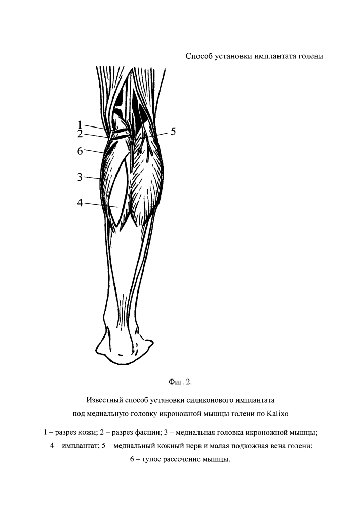 Способ установки имплантата голени (патент 2626267)