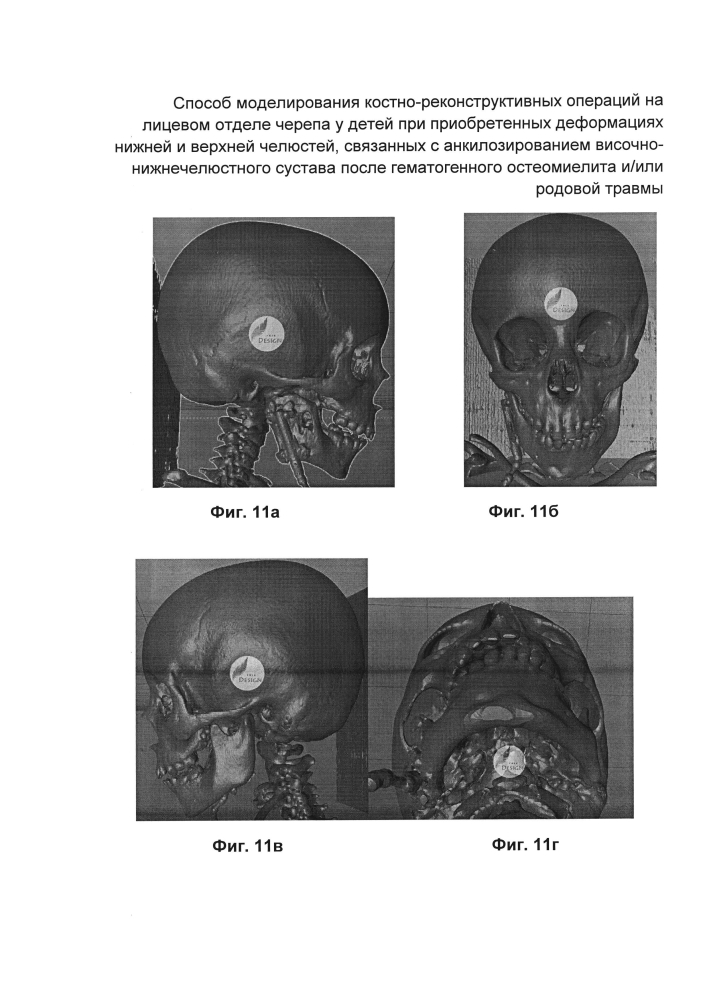 Способ моделирования костно-реконструктивных операций на лицевом отделе черепа у детей при приобретенных деформациях нижней и верхней челюстей, связанных с анкилозированием височно-нижнечелюстного сустава после гематогенного остеомиелита и/или родовой травмы (патент 2604774)