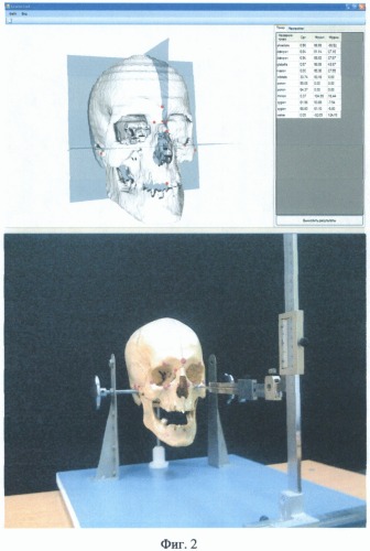 Способ прижизненного определения краниометрических параметров (патент 2499558)