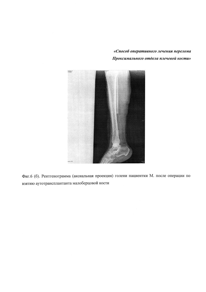 Способ хирургического лечения перелома проксимального отдела плечевой кости (патент 2652573)
