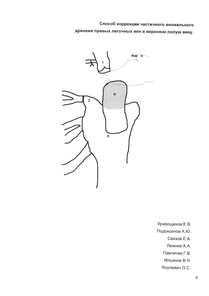 Способ коррекции частичного аномального дренажа правых легочных вен в верхнюю полую вену (патент 2604716)