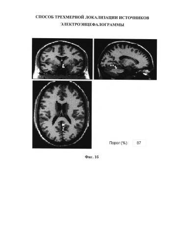Способ трехмерной локализации источников электроэнцефалограммы (патент 2584086)