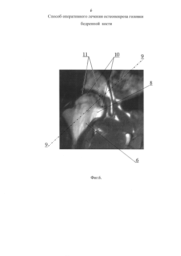 Способ оперативного лечения остеонекроза головки бедренной кости (патент 2578833)