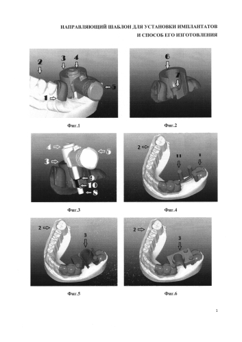 Направляющий шаблон для установки имплантатов и способ его изготовления (патент 2574575)