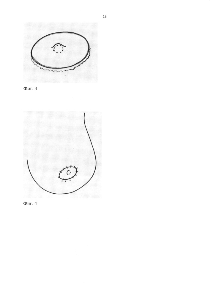 Способ хирургического формирования ареолы и соска на молочной железе (патент 2647154)