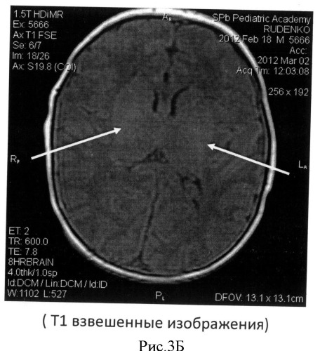 Способ определения зрелости церебральных структур у недоношенных новорожденных (патент 2491888)