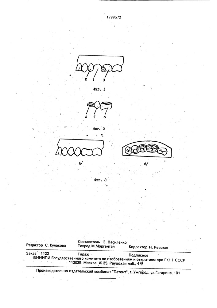 Способ протезирования малого дефекта зубного ряда (патент 1799572)