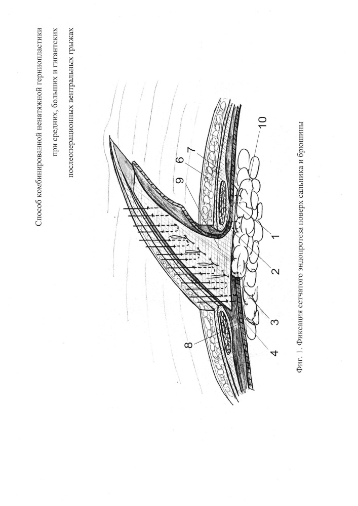 Способ комбинированной ненатяжной герниопластики при средних, больших и гигантских послеоперационных вентральных грыжах (патент 2653816)