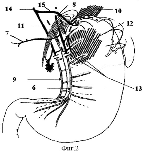 Способ селективной желудочной ваготомии (патент 2269946)