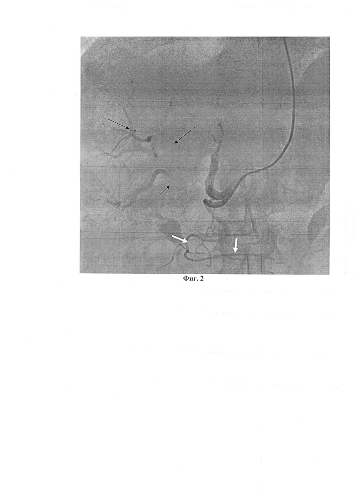 Способ рентгенэндоваскулярной эмболизации висцеральных ветвей через артерии верхних конечностей при помощи катетера headhunter при различных патологиях желудочно-кишечного тракта (патент 2652743)