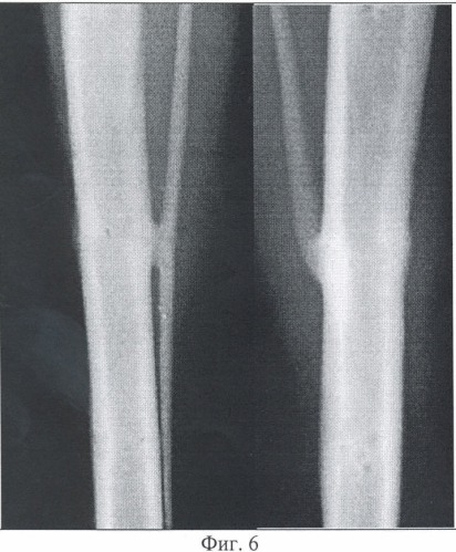Способ механической стимуляции замедленного остеогенеза при переломах костей (патент 2354322)