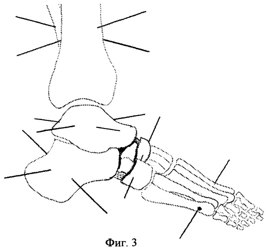 Способ оперативной коррекции деформаций стопы (патент 2412661)