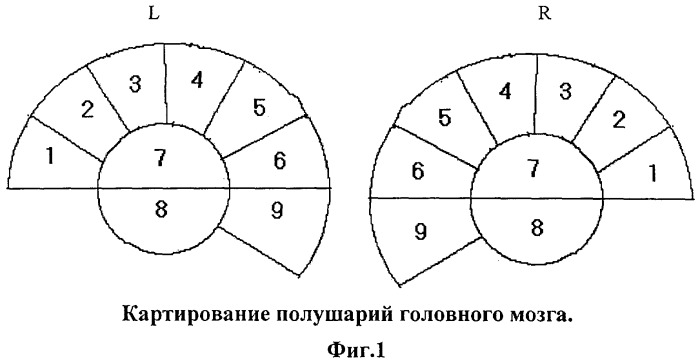 Способ диагностики функциональных изменений у больных с цервикальной дистонией (патент 2386397)