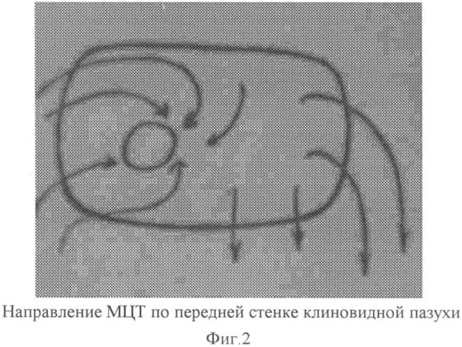 Способ проведения оперативного лечения заболеваний клиновидной пазухи (патент 2350288)