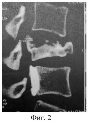 Способ диагностики состояния задней продольной связки средней опорной структуры позвоночника при повреждениях грудного и поясничного отделов позвоночного столба (патент 2508906)