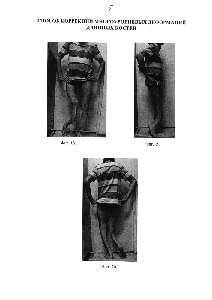 Способ коррекции многоуровневых деформаций длинных костей (патент 2640999)