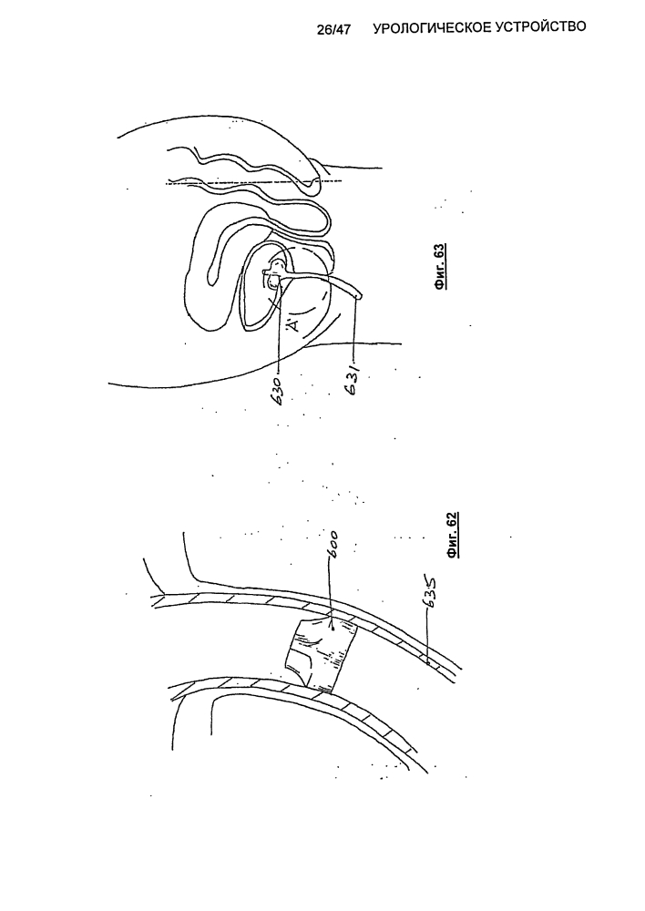 Урологическое устройство (патент 2600865)